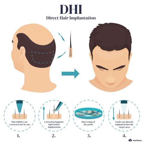 dhi hair transplant dubai cost